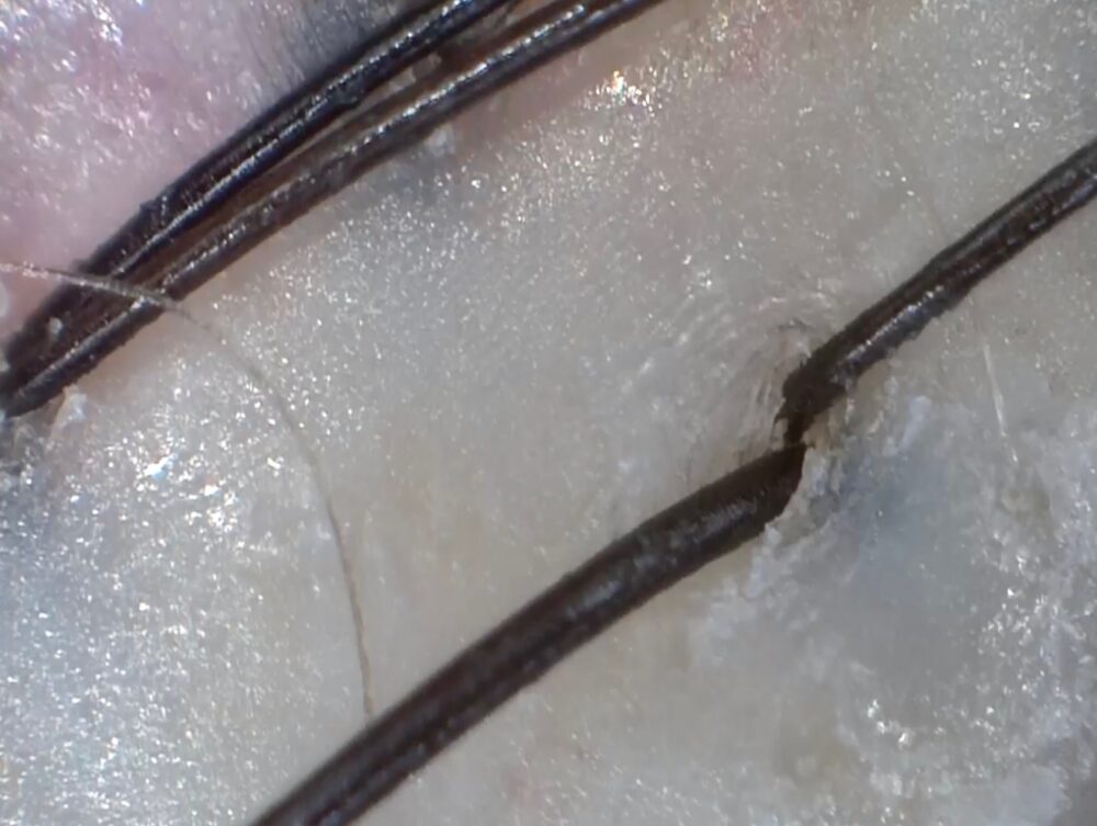 YOLUリラックスナイトリペアシャンプーを継続使用した頭皮状態をマイクロスコープで見た画像